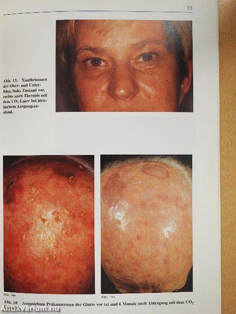 Dermatologische Lasertherapie