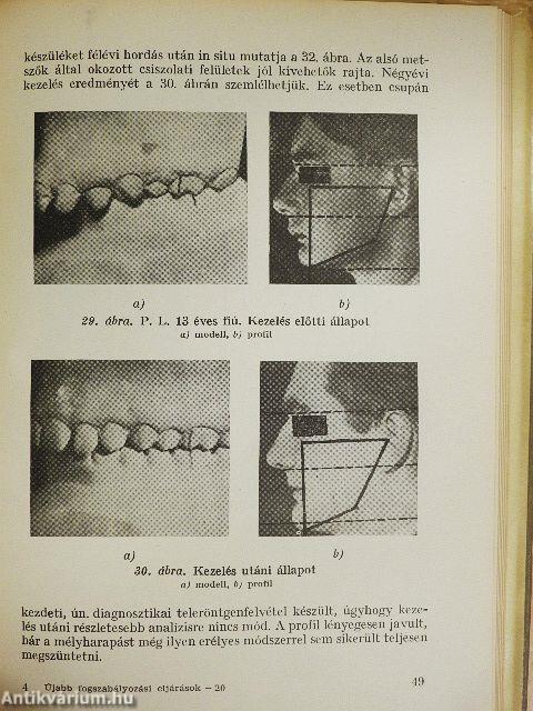 Újabb fogszabályozási eljárások és műanyagaik