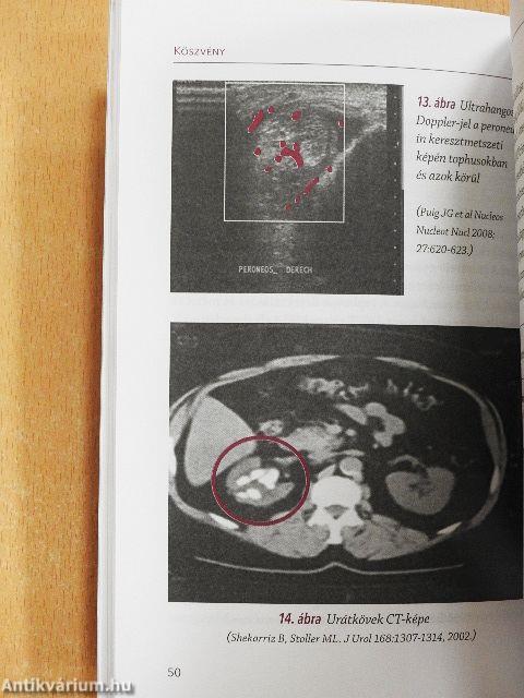 Köszvény és más kristálybetegségek