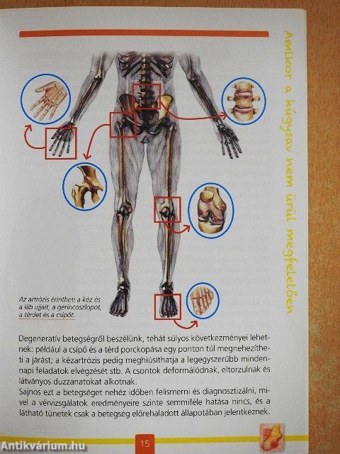 A köszvény, avagy húgysavtúltengés