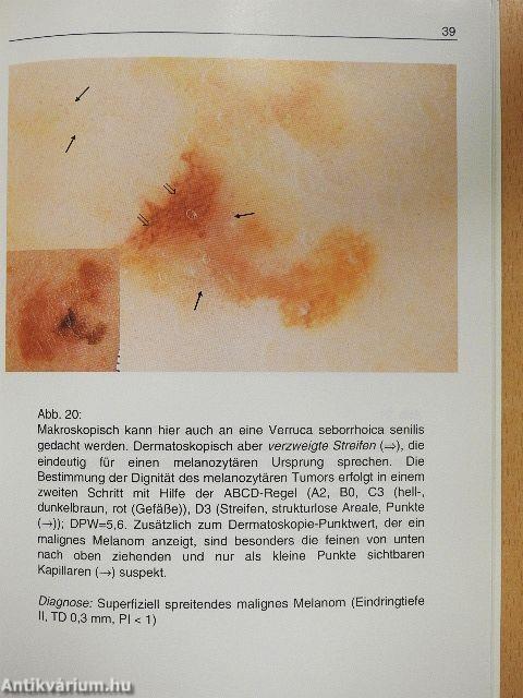 Kompendium zur Differentialdiagnose pigmentierter/Hautveränderungen mit Hilfe des Dermatoskops