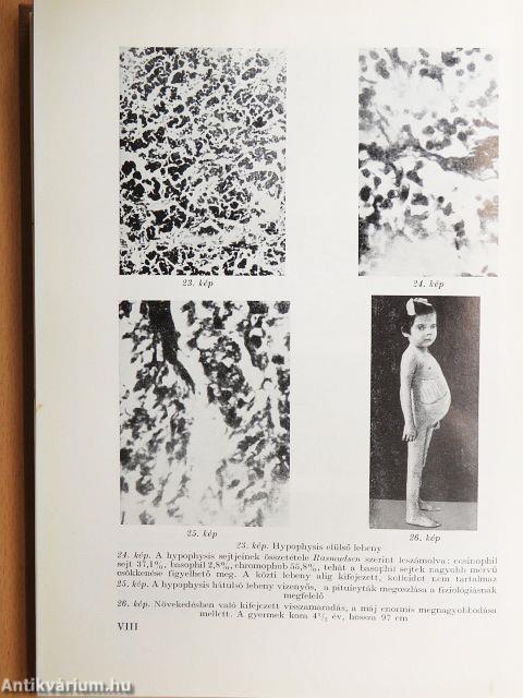 Diabetes mellitus csecsemő- és gyermekkorban