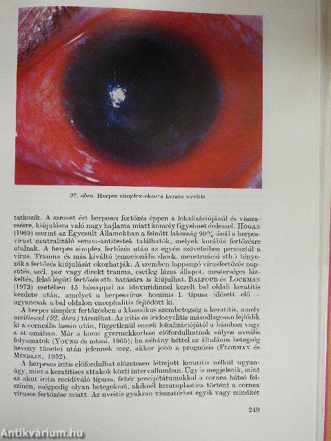 Az endogen uveitisek és általános orvosi vonatkozásaik