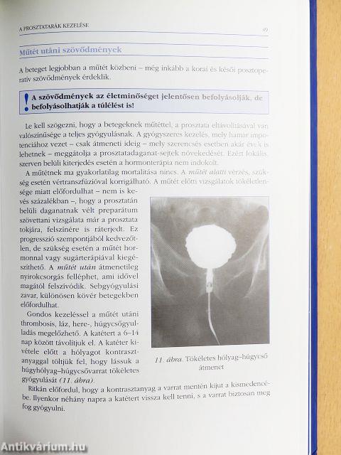 A prosztata betegségei
