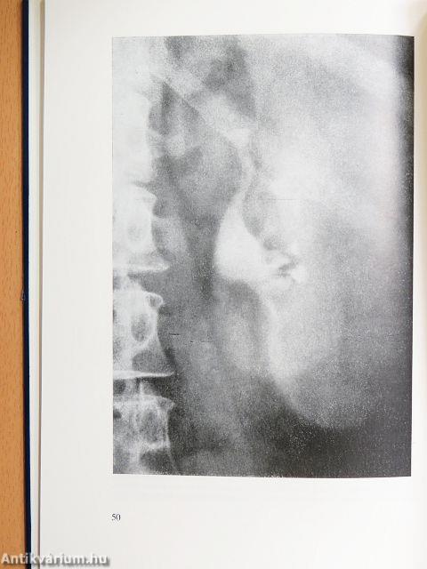 Polycythaemia rubra vera klinikuma, pathologiája és korszerű kezelése