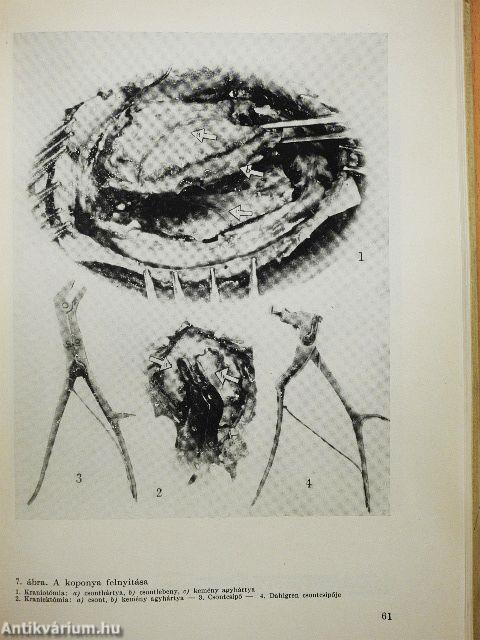 Az agysebészet története