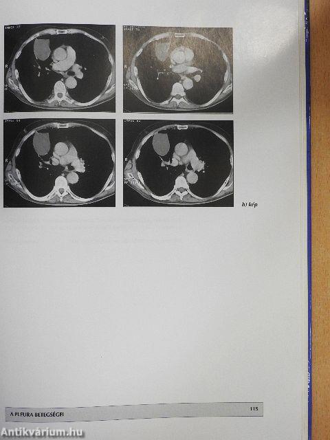 A tüdő megbetegedéseinek röntgenatlasza