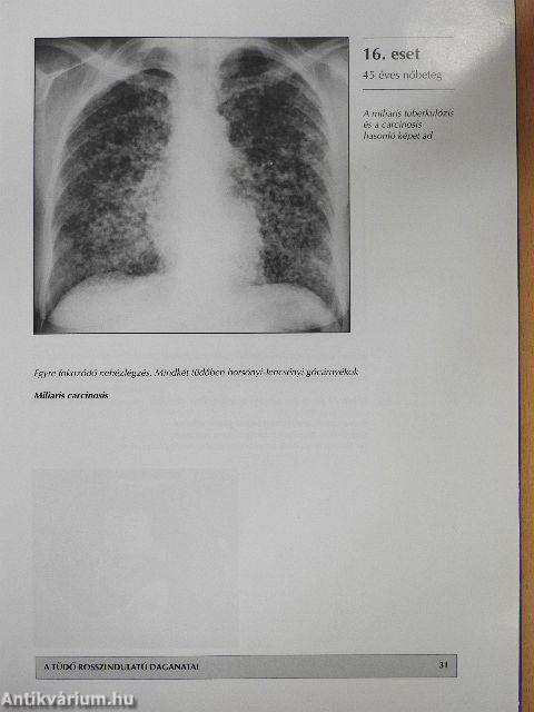 A tüdő megbetegedéseinek röntgenatlasza