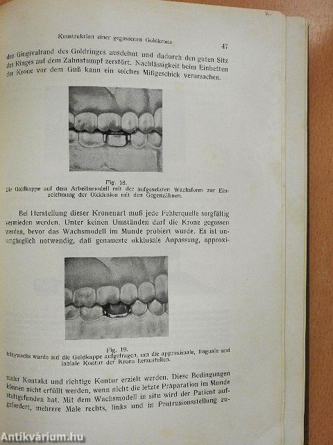 Kronen- und Brückenarbeiten