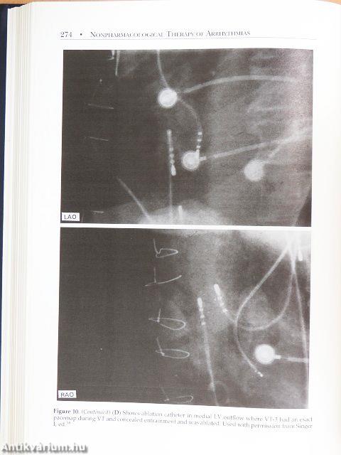 Nonpharmacological Therapy of Arrhythmias for the 21st Century