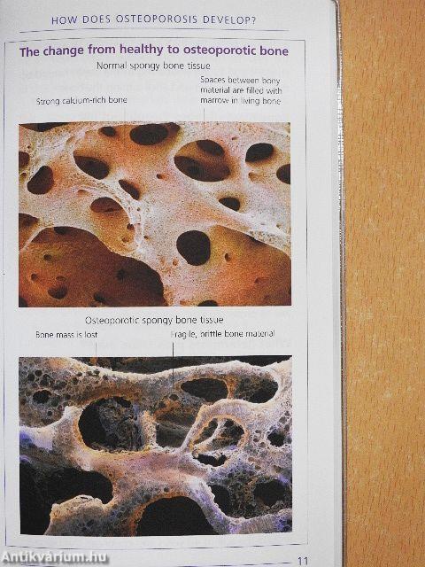 Understanding Osteoporosis