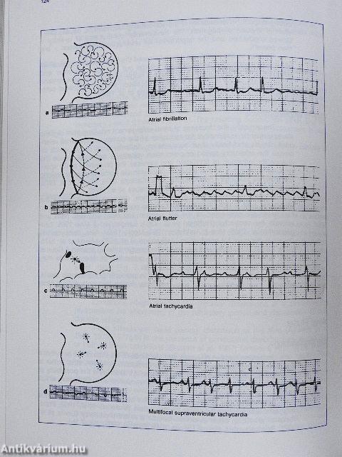 Disorders of Cardiac Rhythm: Focus on Disopyramide