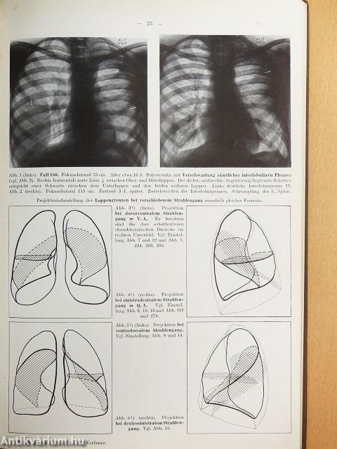Röntgenatlas Frühtuberkulöser Veränderungen im Hilus