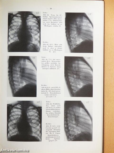 Röntgenatlas Frühtuberkulöser Veränderungen im Hilus