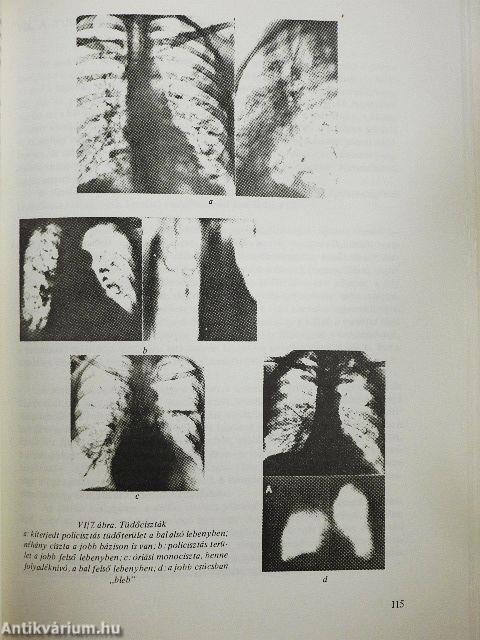A tüdő röntgendiagnosztikája