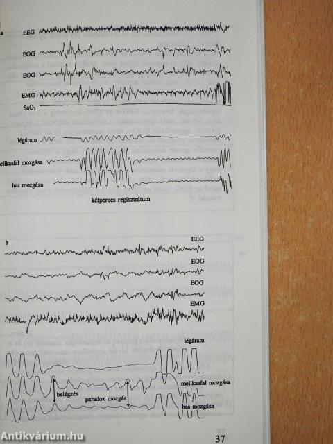 Légzészavarok alvás alatt (dedikált példány)