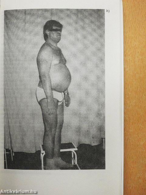 Metabolikus X szindróma