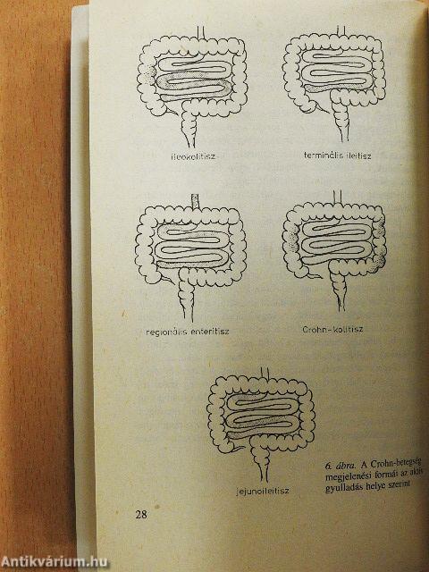 Amit a vastagbélgyulladásról tudni kell