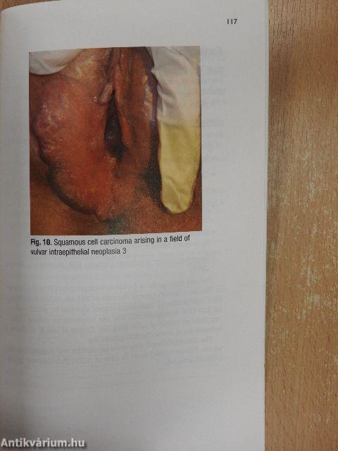 Vulvar Disorders