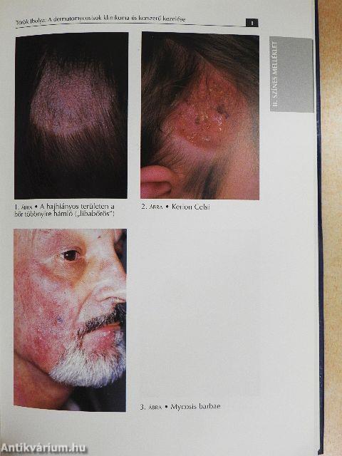 Az orvosi mikológia gyakorlati kérdései