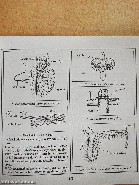A sztómaviselők életminősége és étrendje