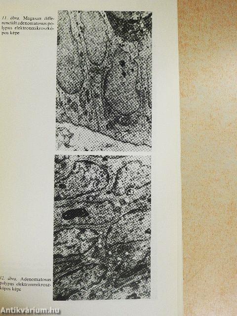 Colorectalis tumorok és rákelőző állapotok patológiája, epidemiológiája, korszerű diagnosztikája és terápiája