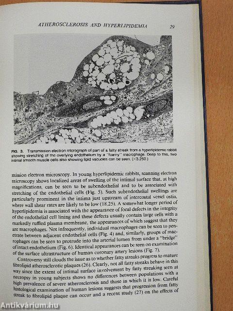 Hypercholesterolemia