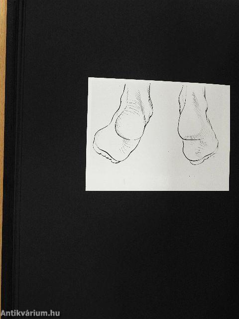 Egyes statikai lábbetegségek megelőzése jól szerkesztett gyermekcipővel I-II.