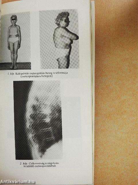 Anyagcsere-csontbetegségek a felnőttkorban