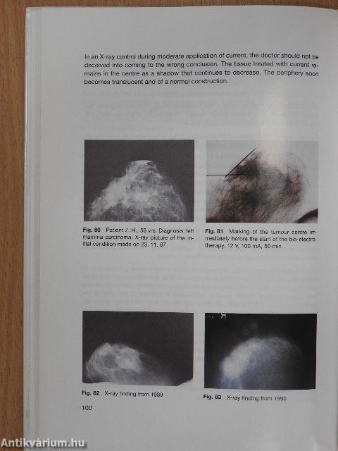 Percutaneous Bio-Electrotherapy of Cancerous Tumours