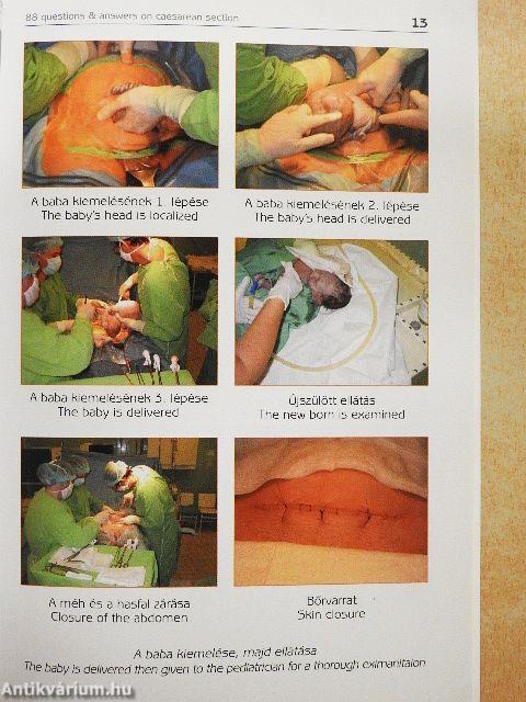 88 kérdés és válasz a császármetszésről