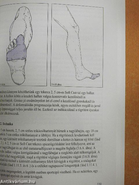 3M rögzítések Soft Cast-ból