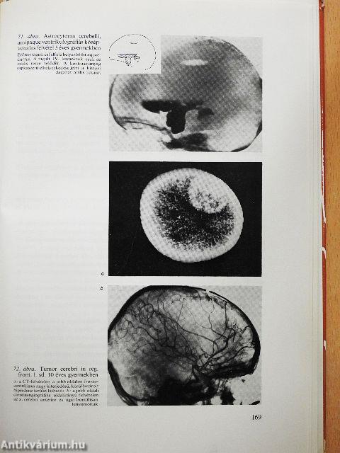 Csecsemő- és gyermekneurológia