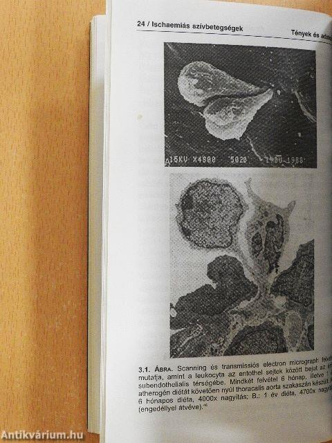 Ischaemiás szívbetegségek