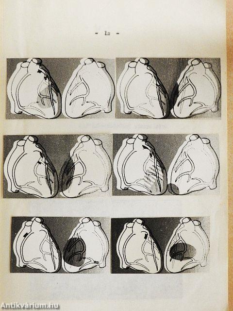 A gyógytorna szerepe a szivmütéten és a szivizominfarktuson átesett betegek rehabilitációjában