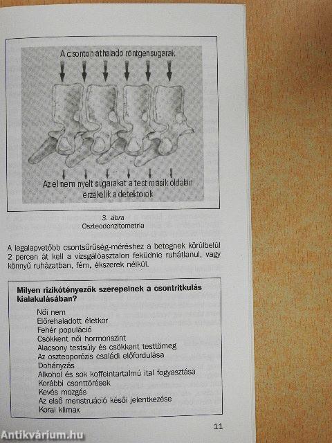 Tanácsok és receptek a csontritkulás kezeléséről és a megelőzésről