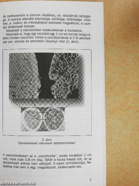 Tanácsok és receptek a csontritkulás kezeléséről és a megelőzésről