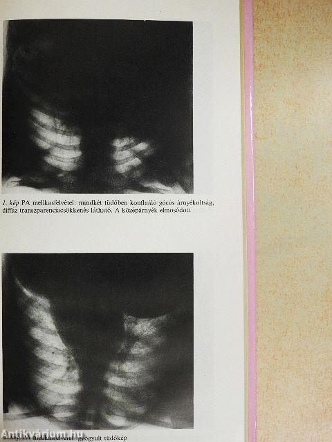 Heveny légzési elégtelenség