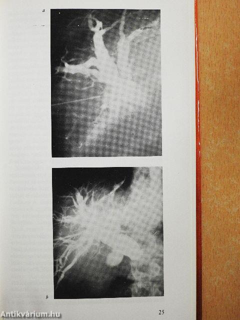 Perkután diagnosztikus és terápiás beavatkozások elzáródásos sárgaságban