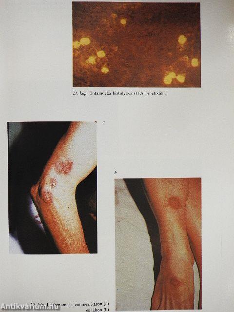 Trópusi betegségek