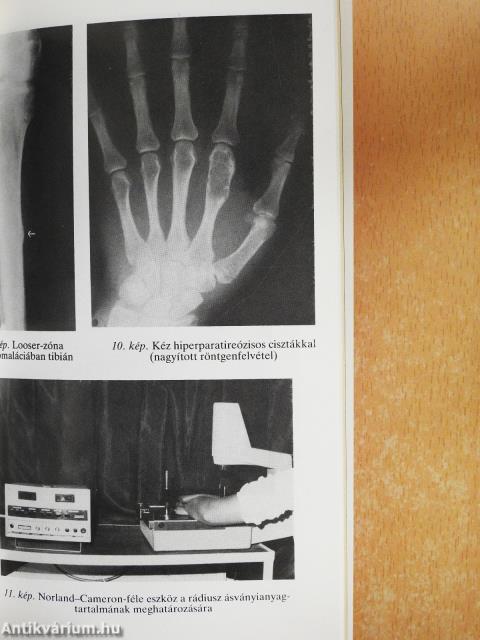 Anyagcsere-csontbetegségek a felnőttkorban (dedikált példány)