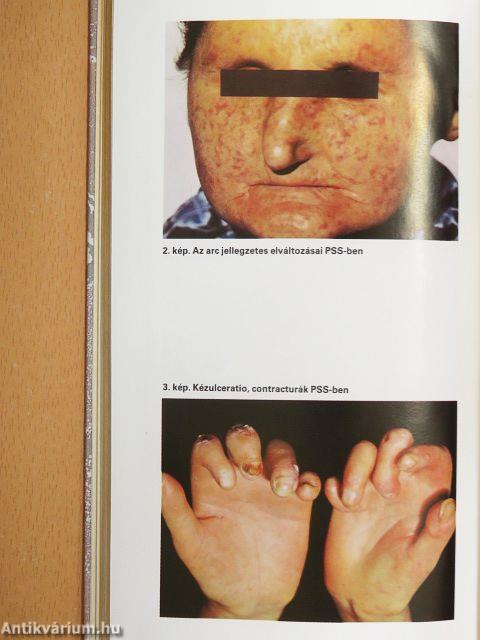 Fibrosissal járó kórképek