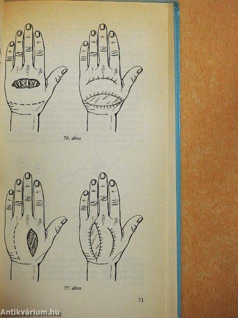 Kézsérülések ellátásáról képekben