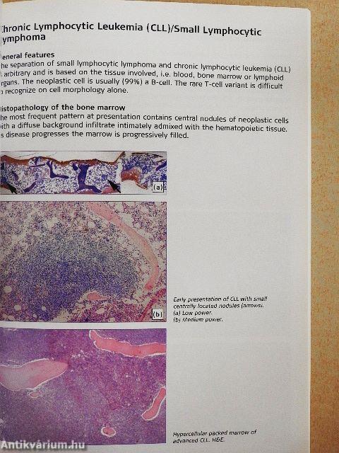 The Illustrated Guide to Bone Marrow Diagnosis
