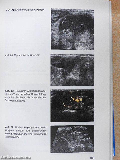 Schilddrüsenkrankheiten