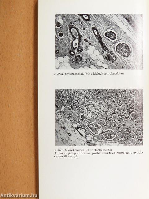 A daganatok áttétképzése