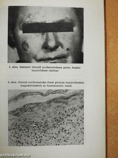 Collagen betegségek