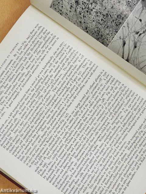 The Pathology of Tumours of the Nervous System