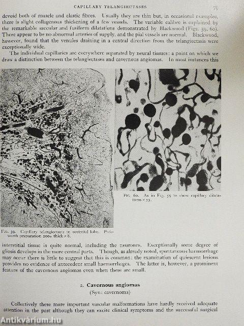 The Pathology of Tumours of the Nervous System