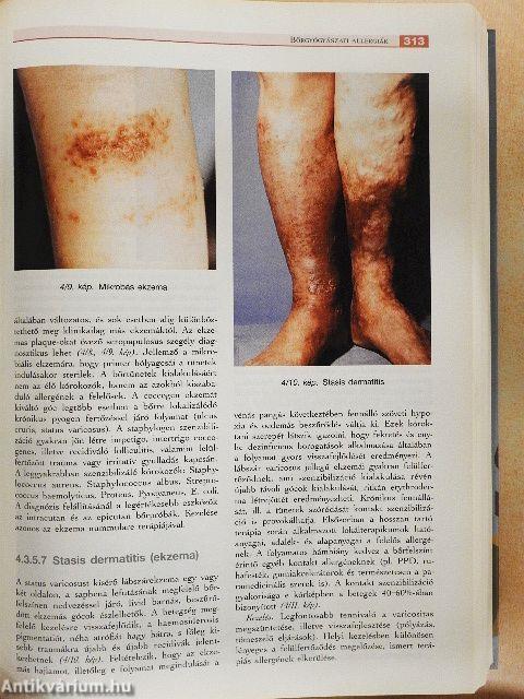 Klinikai immunológia